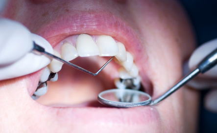 Patient with a mouth full of cavities