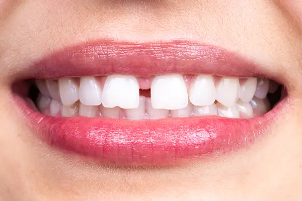 Close-up of a woman's smile with a visible chipped front tooth, highlighting cosmetic dental issues.