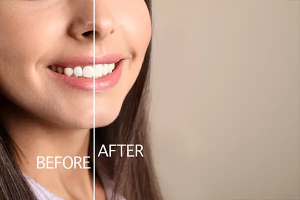 Side-by-side before and after image showing a woman's improved smile symmetry and gum contour after gingival contouring.